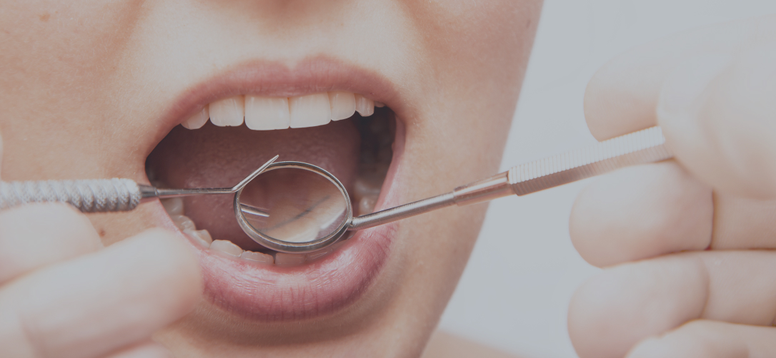 Cuidar tus Implantes Dentales