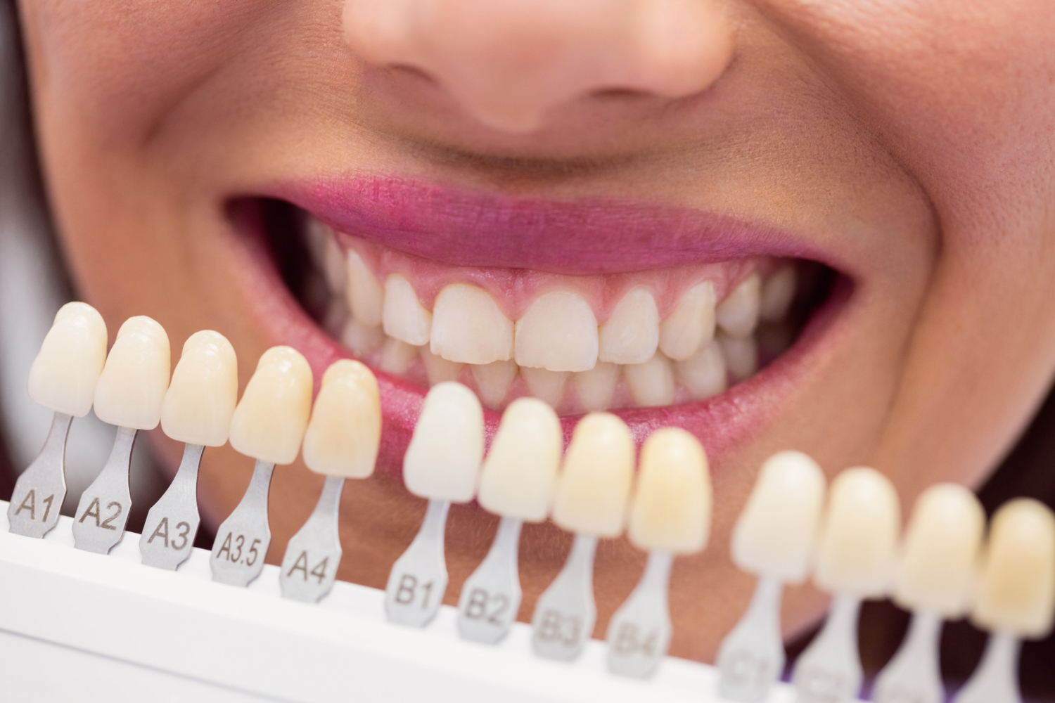 Mitos sobre el blanqueamiento dental