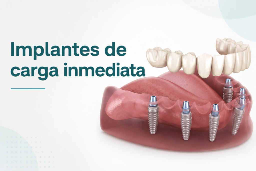 Implantes de carga inmediata