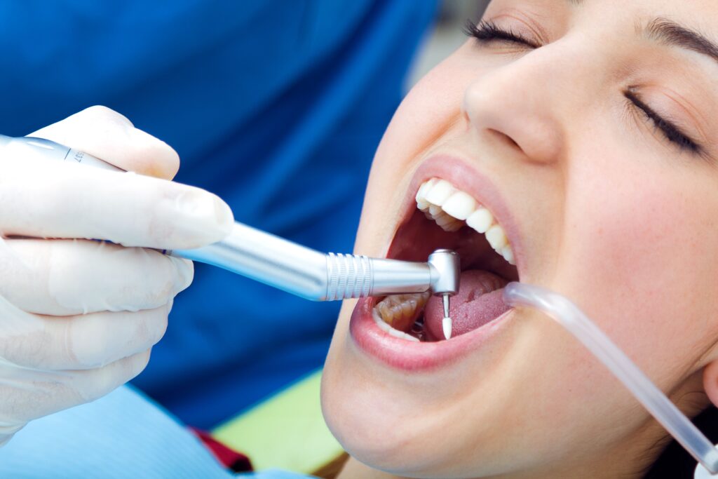 Limpieza dental profunda: cuándo es necesaria y qué diferencias tiene con una limpieza convencional