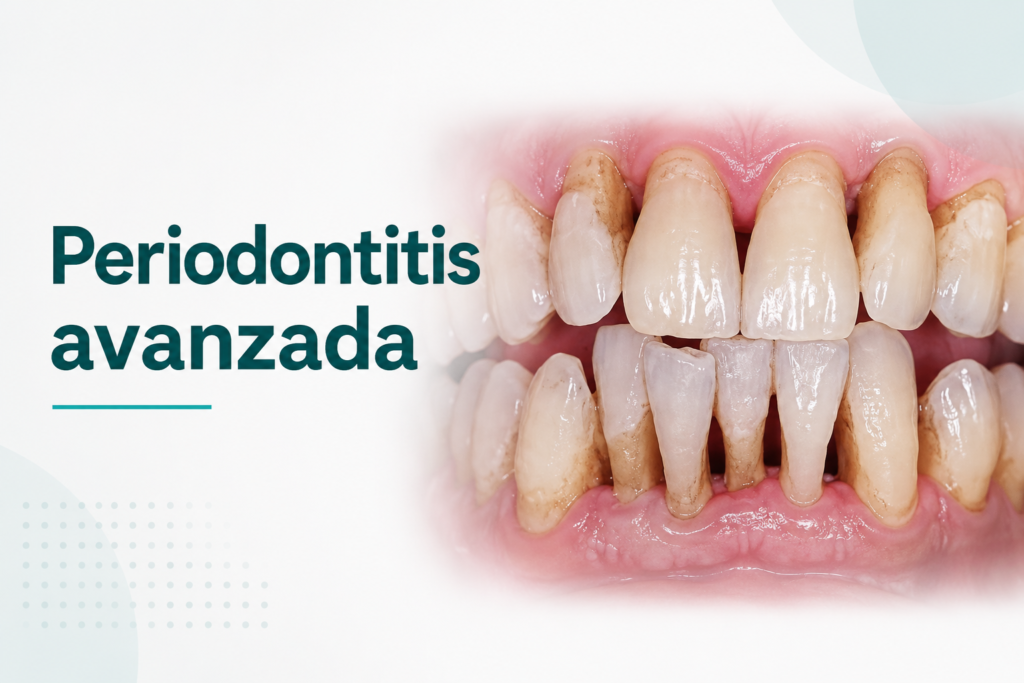 Periodontitis avanzada: síntomas, tratamientos y cuándo se puede salvar un diente